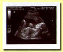 Sonogram pic